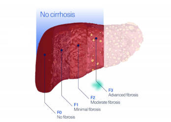 Ready to diagnose HCV?